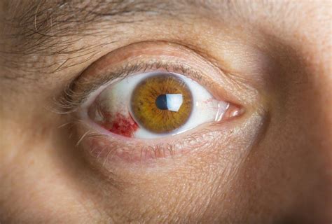 blood leaking from eye|Subconjunctival Hemorrhage: Symptoms, Causes